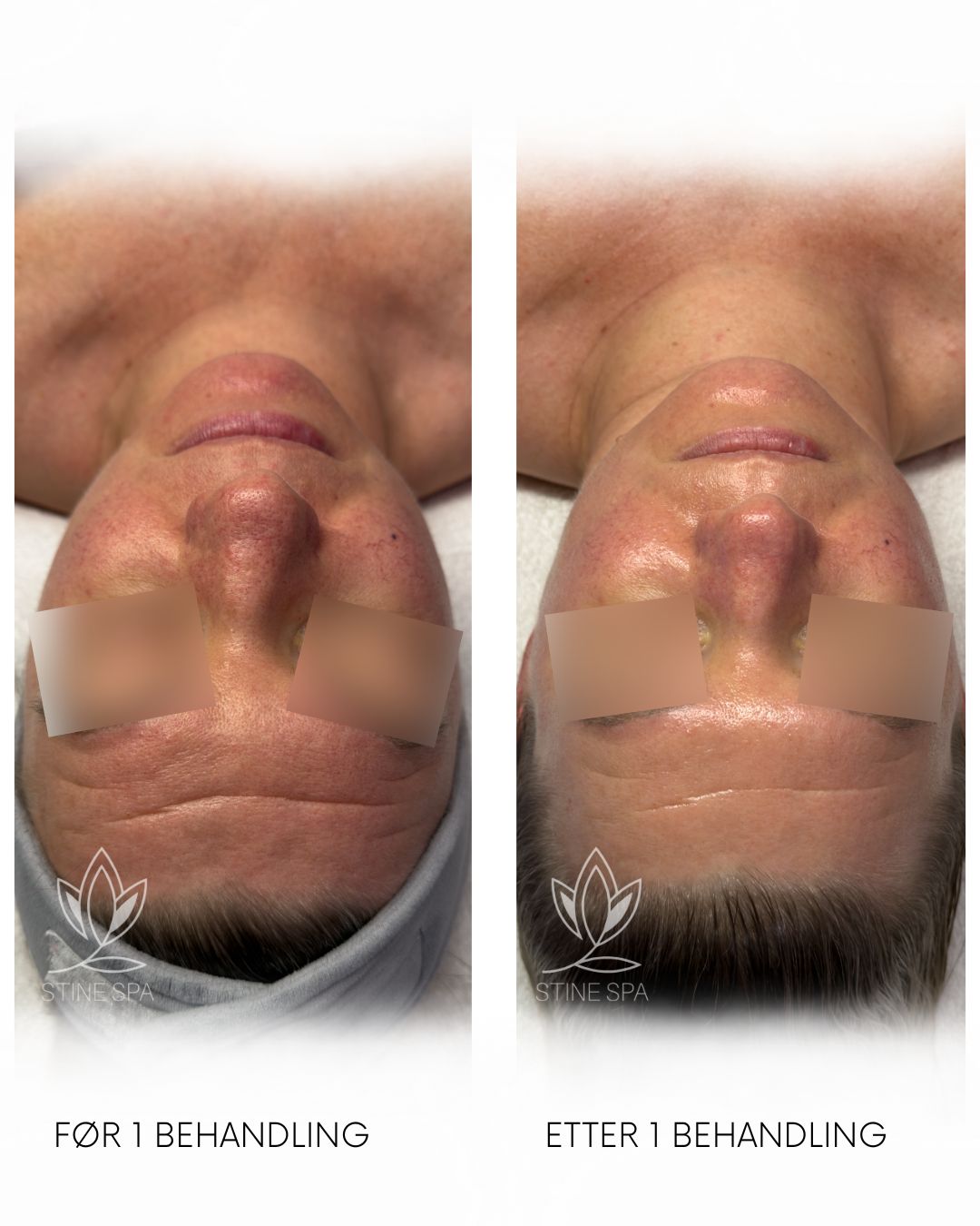 Hydrogen behandling stine spa