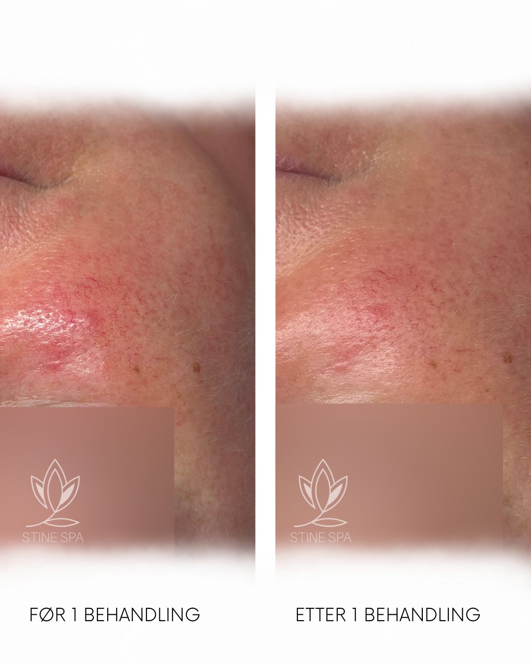 Hydrogen behandling stine spa